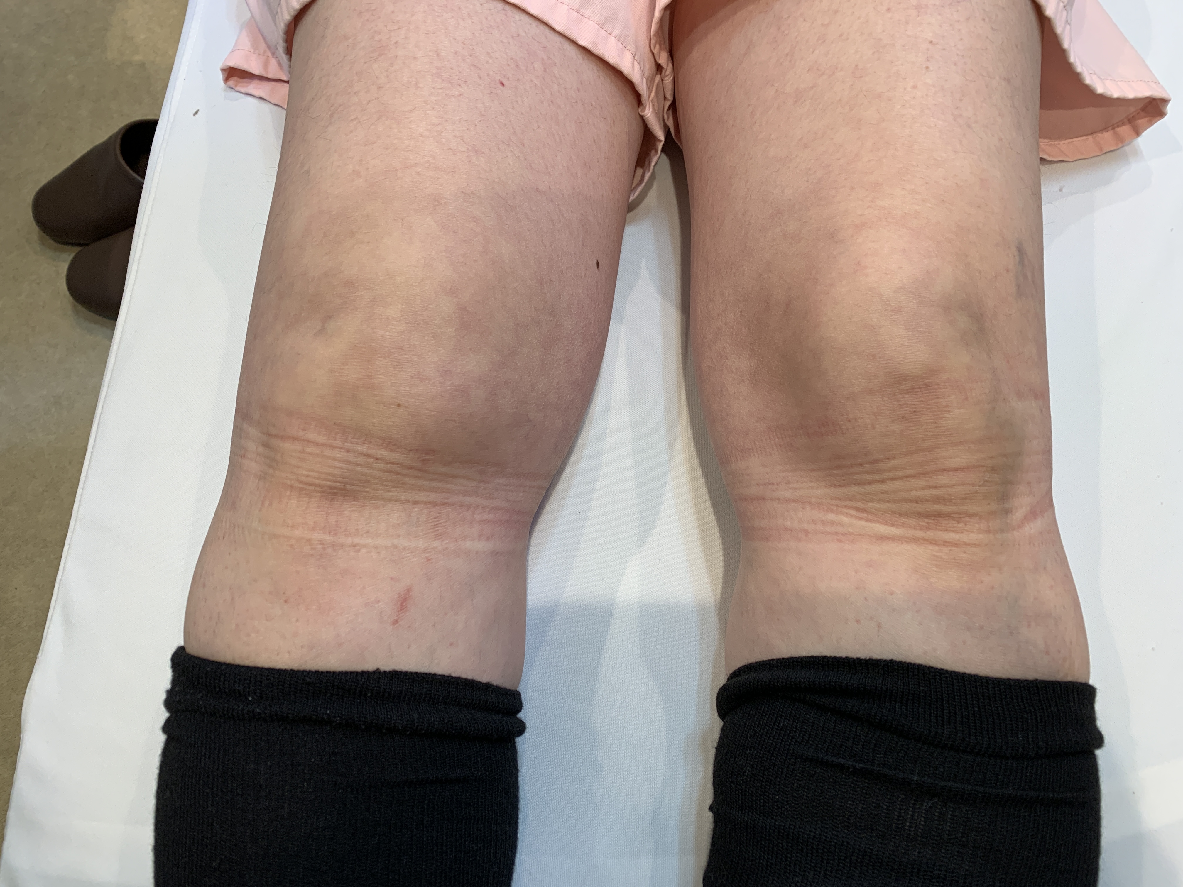 腰の不調が膝に及ぼす影響、正しい治療法を見つけよう！